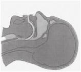 Place one or two fingers under the anterior mandible to raise the chin and gently tilt the head. Care should be taken with trauma victims and with children under 5 years of age.