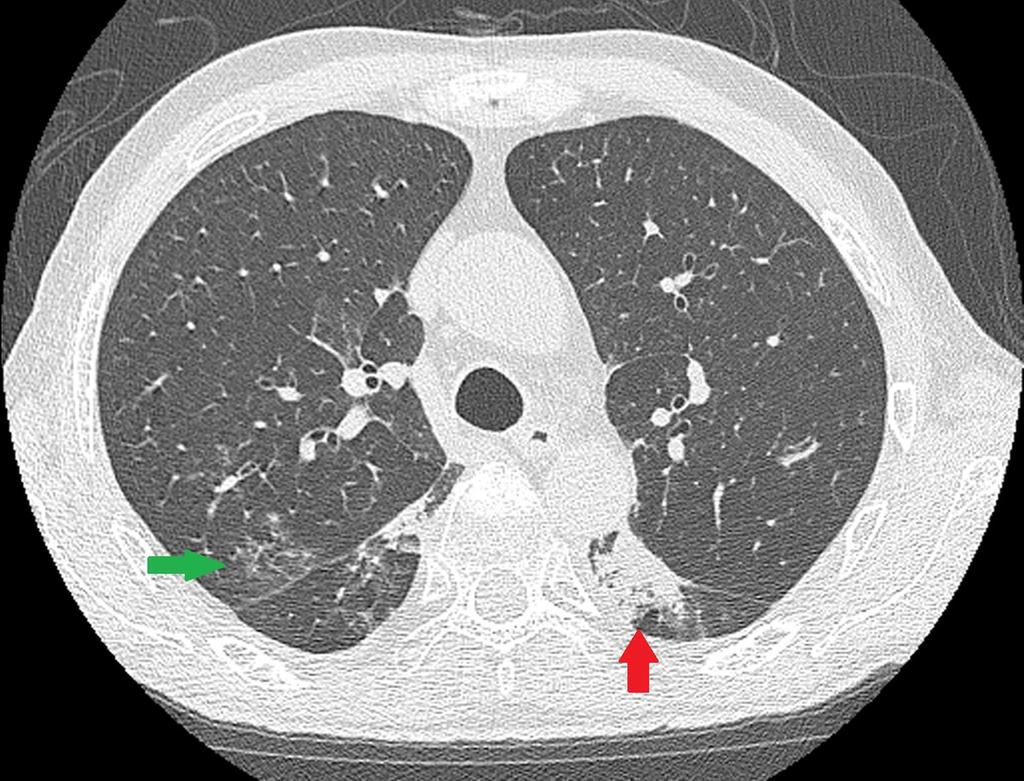 Fig. 3: Axial HRCT of a patient with radiation pneumonitis shows ground-glass
