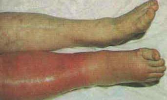 3. DeeP vein thrombosis (Dvt) This is where a clot lodges in one of the larger veins of a leg or arm.
