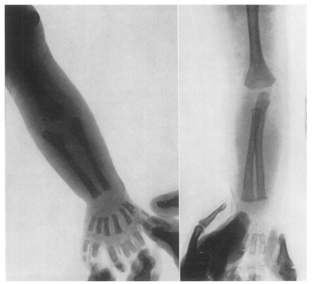 3 X-ray photograph of left hand and forearm. FIG. 4 X-ray photograph of right hand and forearm.