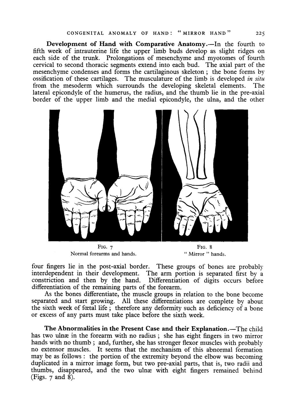 CONGENITAL ANOMALY OF HAND : " MIRROR HAND" 225 Development of Hand with Comparative Anatomy.
