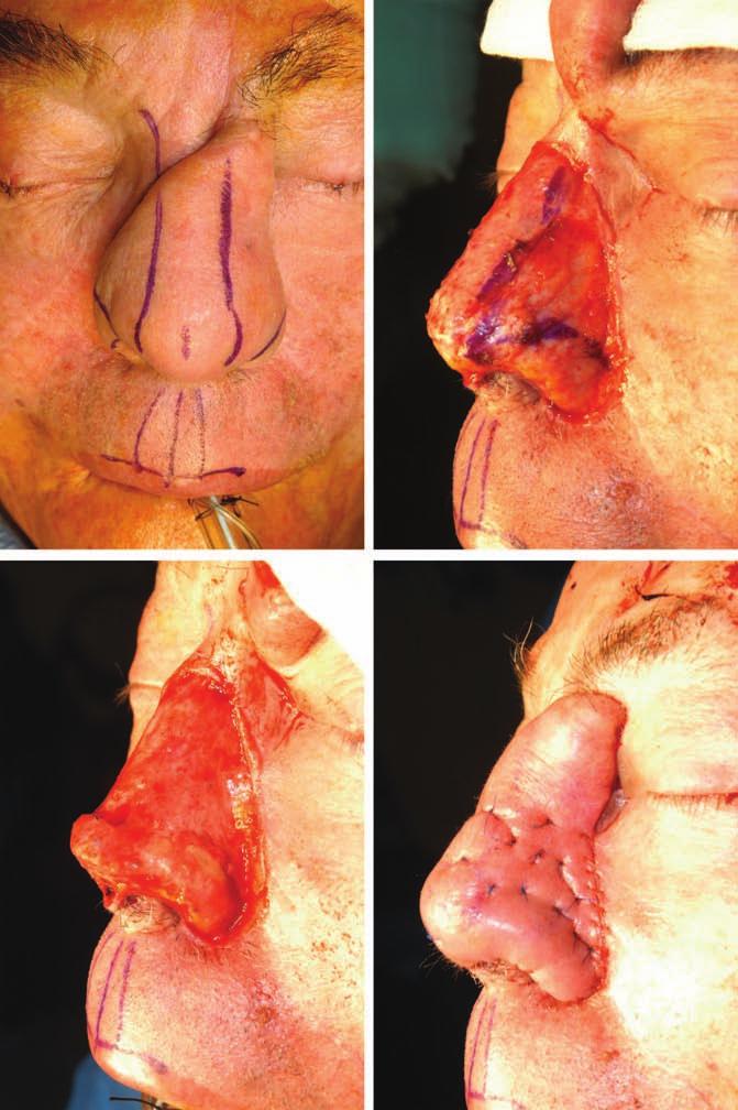Volume 125, Number 4 Nasal Reconstruction Fig. 9. Four weeks later, during the intermediate operation, cover, support, and lining are healed.