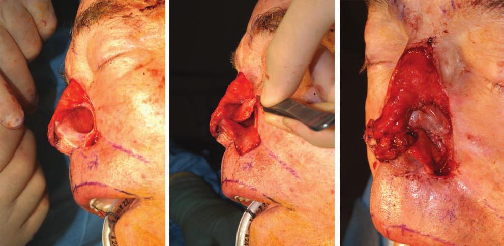 Volume 125, Number 4 Nasal Reconstruction Fig. 7. (Left) The defect is recreated by excision of the skin graft and residual normal skin within the remnant of the right ala.