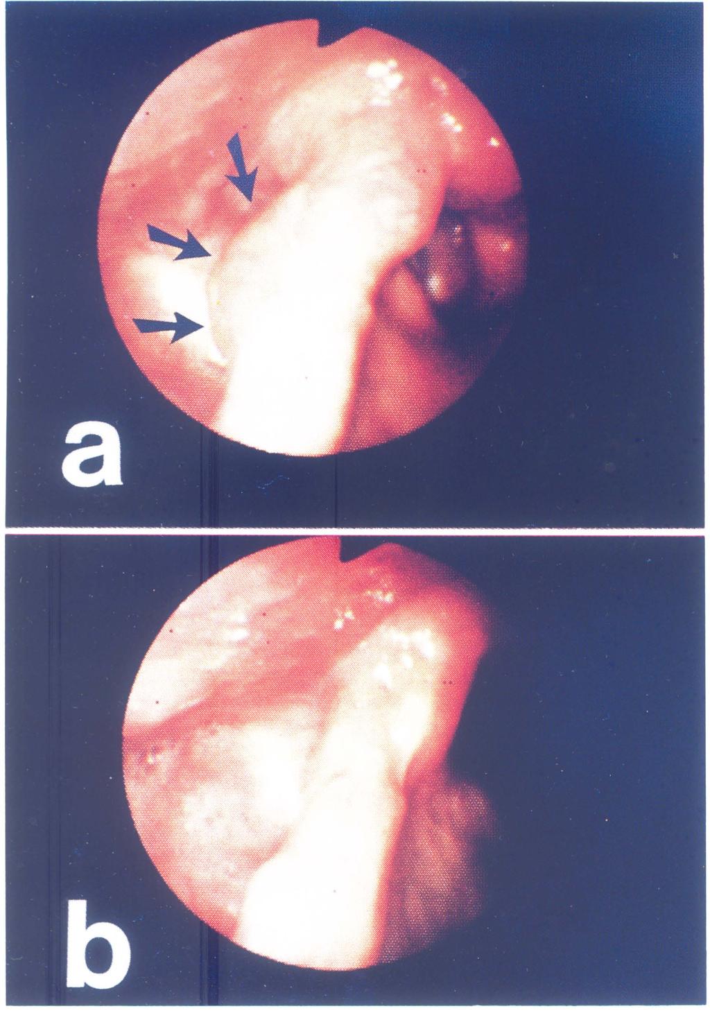 54 M. KAWAIDA et al. Histopathologically, the lesion was identified as a lymphoepithlial cyst (Fig. 4).