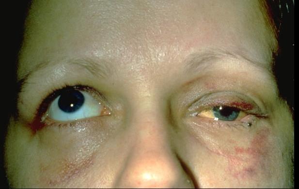 Treatment: Orbital Trauma ORBITAL FRACTURES Assess ocular motility