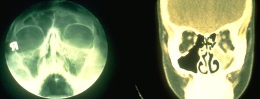Treatment: Orbital Trauma X-ray of skull (Waters or