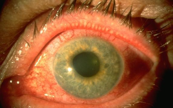 Treatment: Angle Closure ACUTE ANGLE-CLOSURE GLAUCOMA: SIGNS & SYMPTOMS Severe ocular pain Decreased