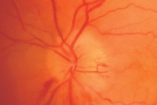 Treatment: Sudden Vision Loss TEMPORAL ARTERITIS: SIGNS AND SYMPTOMS Unilateral loss of vision Afferent