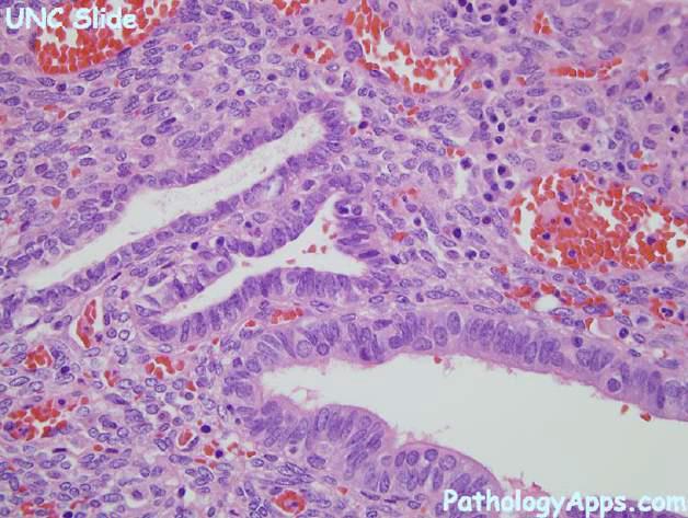 Microscopic features When examined histologically: You can see endometrial glands and stroma. The brown material is hemosiderin-laden macrophages.