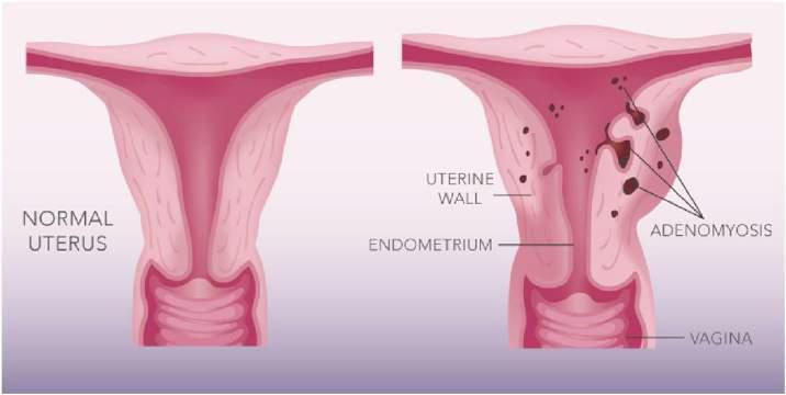 When we section the uterus (we usually take from anterior and posterior), we must see mucosa, submucosa with endometrial glands, myometrium and finally serosa.