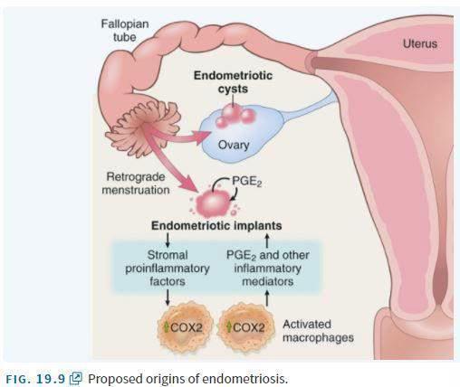 The 3 hallmarks of endometriosis anywhere are benign endometrial glands, stroma and hemosiderin-laden macrophages.