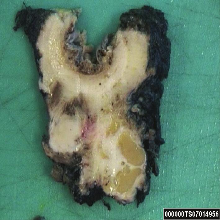 2 Case Reports in Surgery from a presumed low pelvic mass and two persistent filling defects within the descending colon. Colonoscopy showed a pedunculated polyp at 50 cm.