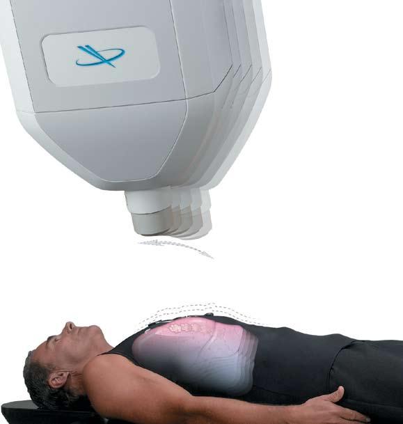 The patient breathes normally while the CyberKnife System delivers highly collimated beams to the moving target.
