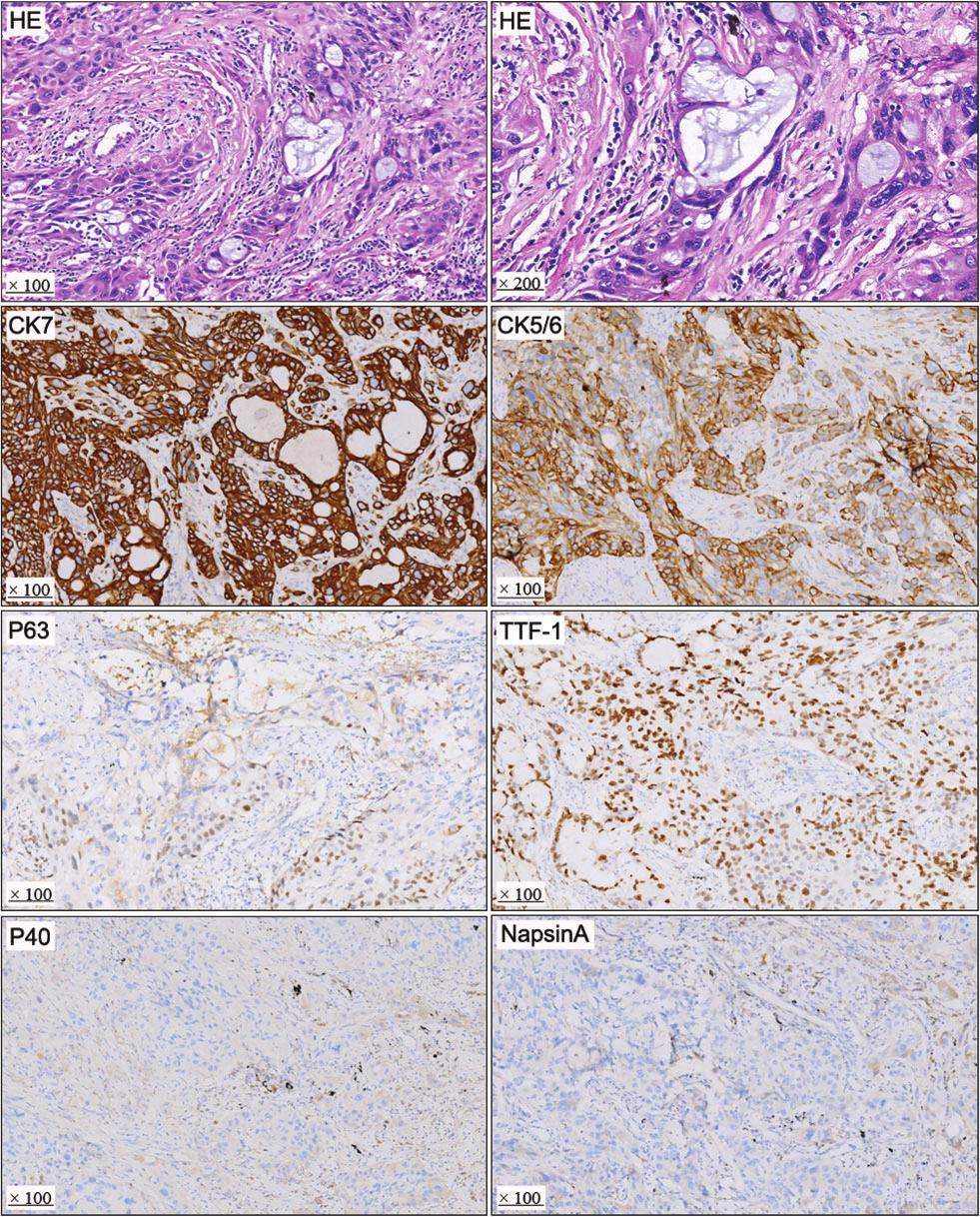 Clinicopathological features of PMEC X. Li et al. Figure 2 Hematoxylin eosin (HE) staining and immunohistochemistry.