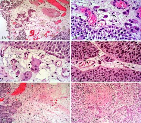 Lamina propria invasion Main Issues to identify Invading epithelium Irregularly shaped nests Single cell infiltration