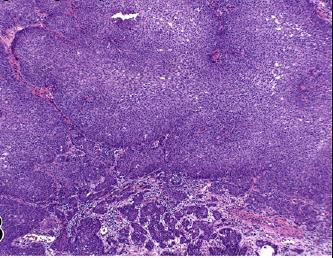 Irregularities of the contours of the neoplastic nests Jagged