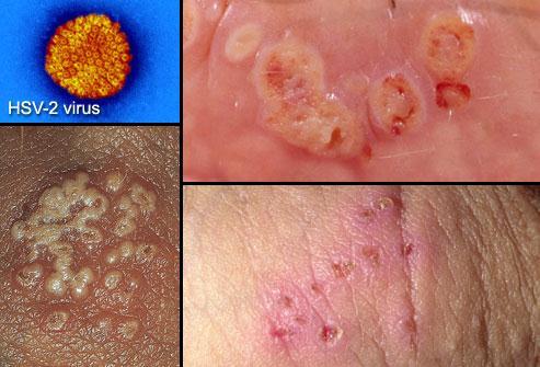 Genital Herpes Caused by herpes simplex virus Simplex 1 causes cold sores in or near the mouth Simplex 2 causes genital sores BOTH can infect the