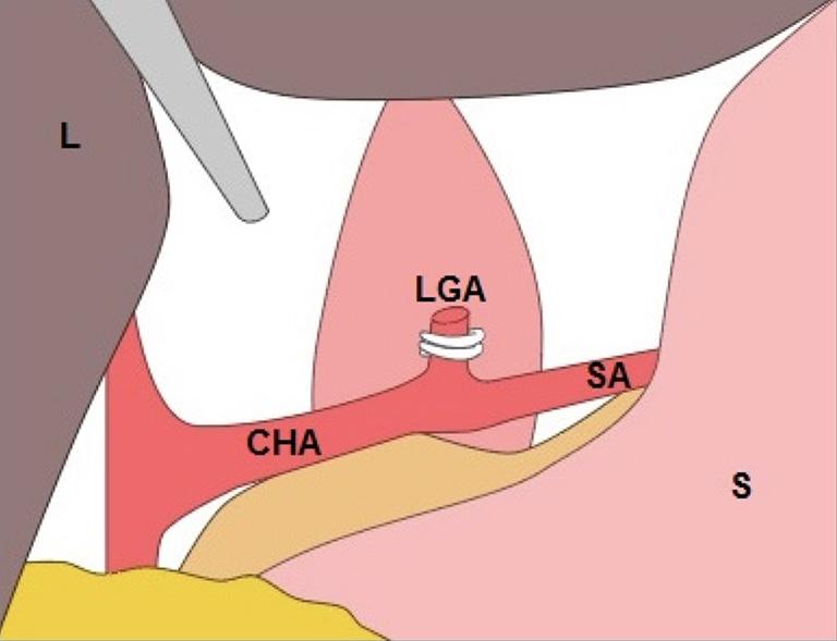 Figure 6 Cervical incision and esophagogastric anastomosis was performed with a circular stapler device.