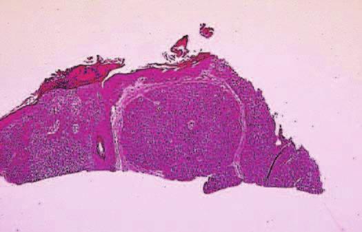 epithelium LOW 6-19 Detail of squamous tumor with