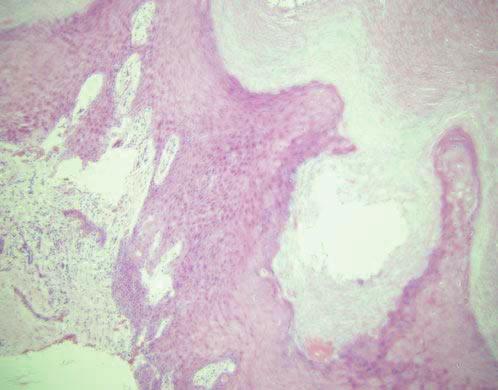 neoplasm with hyperkeratosis and digitate epidermal extensions LOW