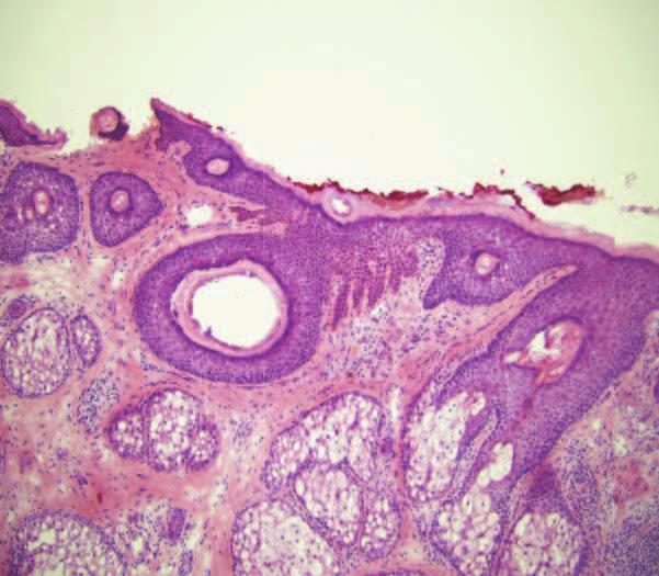 6 Squamous Cell Carcinoma 61 Precursor Lesion Bowenoid Actinic Keratosis Bowenoid