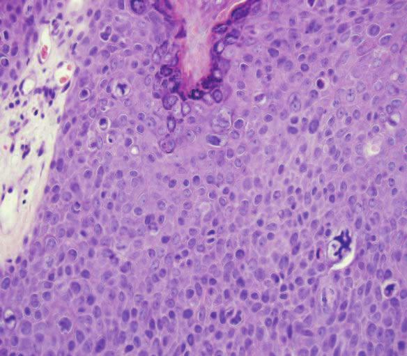 6 Squamous Cell Carcinoma 65 SCC-In-Situ Arising in Verruca (HPV