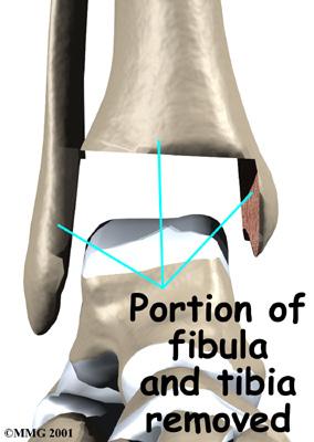 To fit the metal socket in place, the ends of the ankle bones are shaped. The tibia and fibula are shaped first. Next, the top of the talus is shaped so the metal talus component can be inserted.