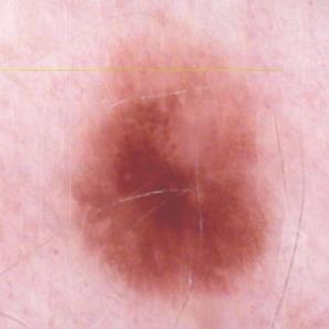 lesions Total body photography Baseline New lesion Detect new nevi