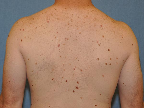 Clinically atypical nevi (2-4x) Family h/o melanoma