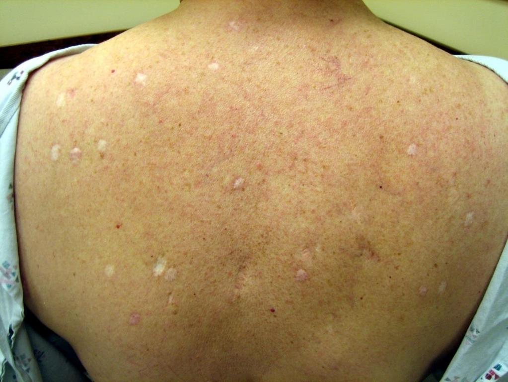 This patient had a molectomy but Nevus-free skin contains vast reservoir of melanocytes that represent potential melanoma precursors