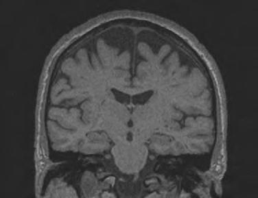 Chapter 1 Figure 2 Hippocampal atrophy Coronal T1-weighted MRI scans of control subject (left) and patient with mild AD (right).