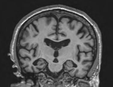 have assessed the diagnostic value of hippocampal atrophy for AD, using various visual, linear and volumetric measurements (for overview see: 29,30 ).