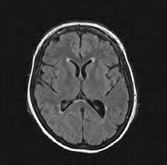 General Introduction Figure 3 Small vessel disease From left to right: Normal, Confluent white matter hyperintensities, and Lacunar infarct on axial Fluid Attenuated Inversion Recovery MRI scans
