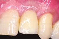 Understand occlusal concepts and guidelines for difficult restorative situations þ Recognize, manage and prevent associated complications Curriculum: þ Prosthetic components