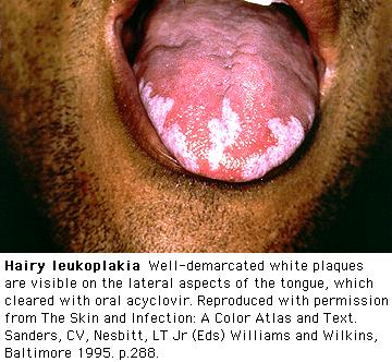 Oral Hairy Leukoplakia Associated with Epstein- Barr virus (EBV) in superficial tongue