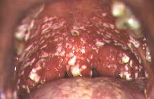 tongue Painless Oral Thrush Caused by Candida albicans White plaques or curd like