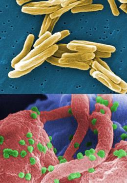 HIV and TB co-infection! Most common opportunistic infection in HIV!