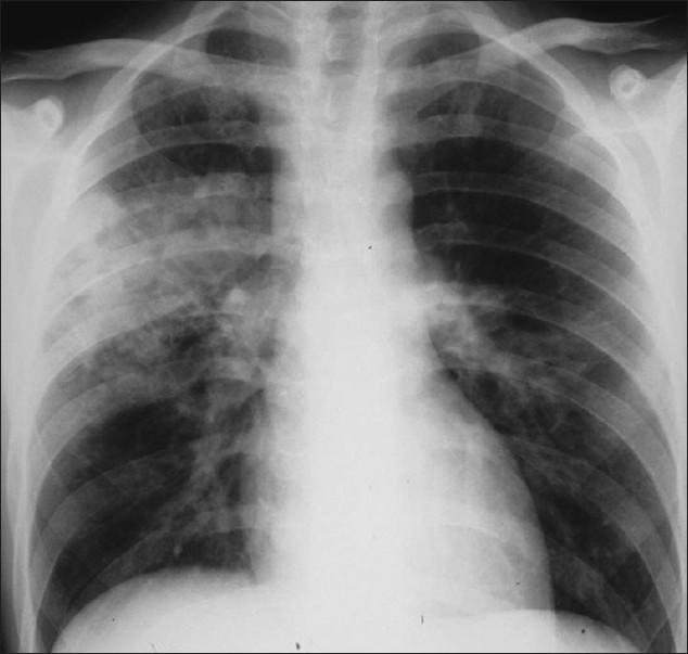 Pulmonary Tuberculosis Symptoms present for weeks to months Fever, productive cough,