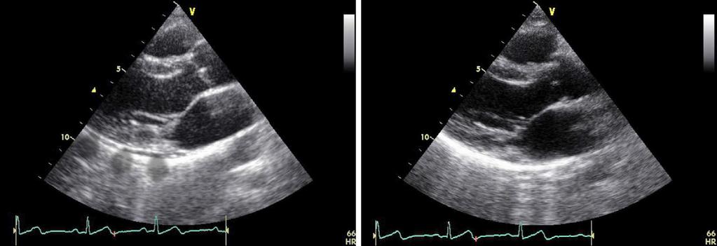 A B Figure 3. Echocardiographic findings. The echocardiographic findings from the first (A) and the second (B) examinations of a 33-year-old woman.