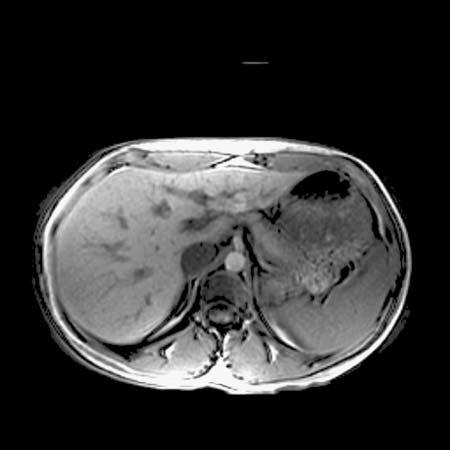 Dig Dis Sci (2007) 52:2629 2632 2631 Fig. 3 MRI of the liver after treatment showing complete resolution of the lesions organisms are identified [4].
