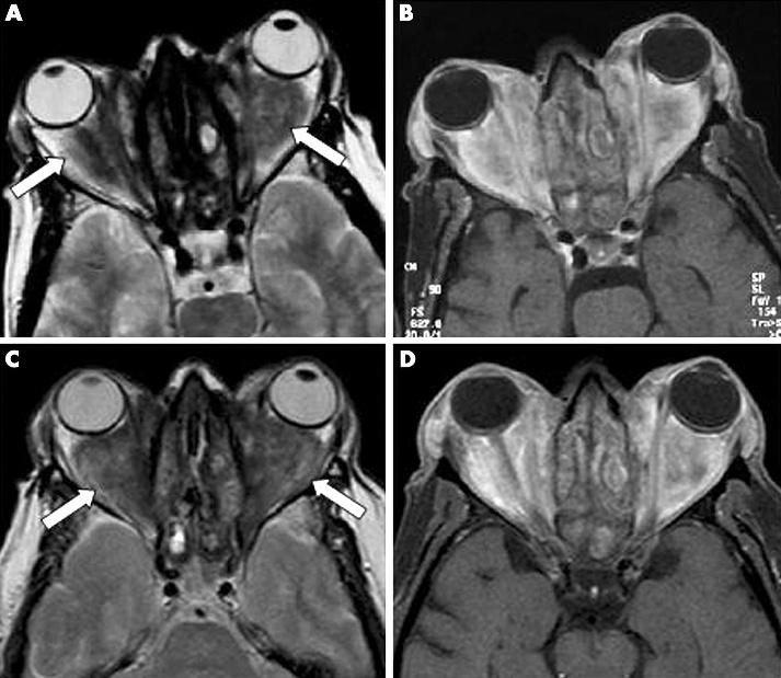 856 Aries,Hellmich,Voswinkel,etal Figure 2 Magnetic resonance imaging of orbital granulomas (patient No 1) before (A, B) and after treatment (C, D) with RTX.