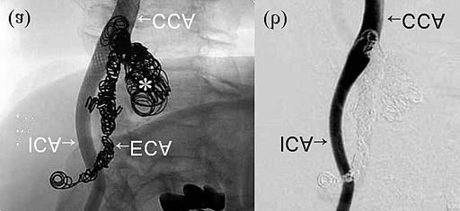 Three-dimensional CT demonstrated two pseudoaneurysms of the right external carotid artery (ECA) that measured 3 cm and 1.5cm in diameter (Figure 1).