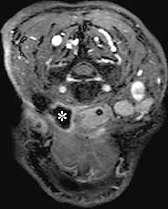 67 embolization could not be controlled, and recurred. Ten months after leaving the hospital, secretion of the pus from the former bleeding point of the neck appeared.