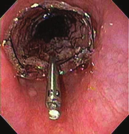 2 Esophageal stent placed over the site of