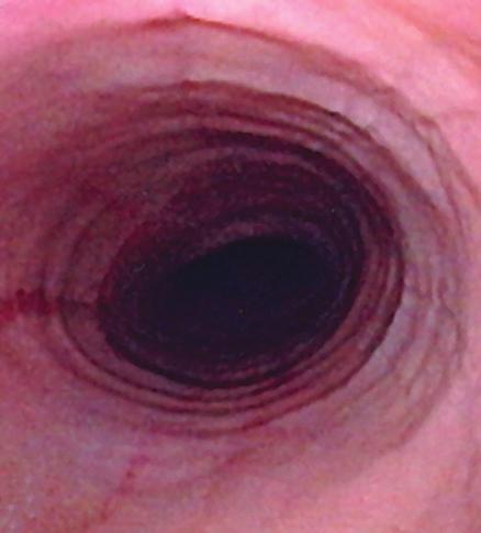 endoscopic clue to the etiology of impaction, which occurred more distally in this patient (not shown). Plate 17.