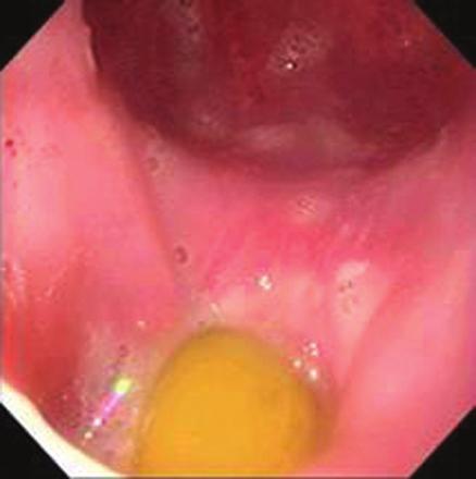 5 Food impaction in a patient with esophageal achalasia.