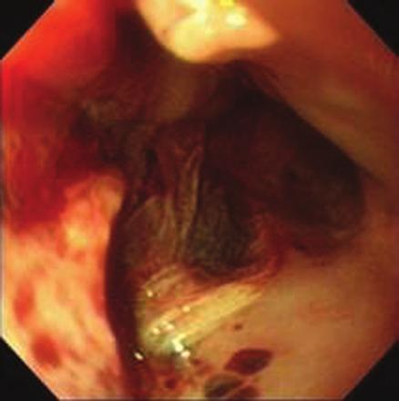 Because of the associated atony and dilation of the esophageal body, water instillation allowed the endoscope to bypass the impaction and