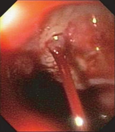 1 Endoscopic picture of huge fundic varices.