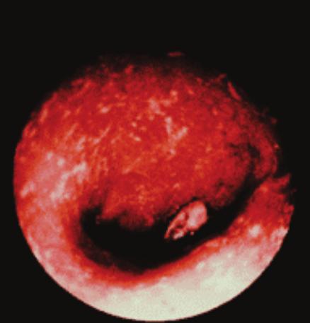 3 Endoscopic pictures showing an acute bleeding