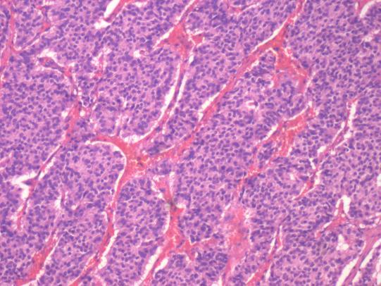 Fig 3: Histological appearance Immunohisto chemistry was done which was positive for synaptophysin and chromogranin.ki 67<5%.